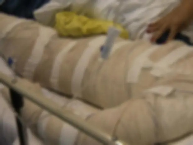 Queimado por amigo em brincadeira com álcool está em coma no CTI da Santa Casa